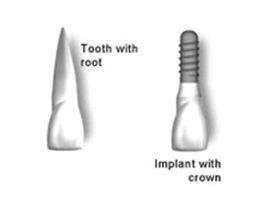 Dental Implants Marlow