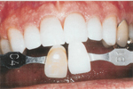 Whitening before