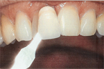 Whitening before