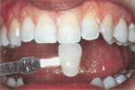 Whitening before