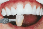 Whitening before