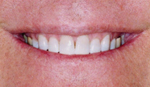 Whitening after